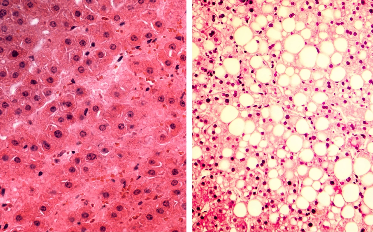 Histologischer Vergleich: gesunde vs. verfettete Leberzellen