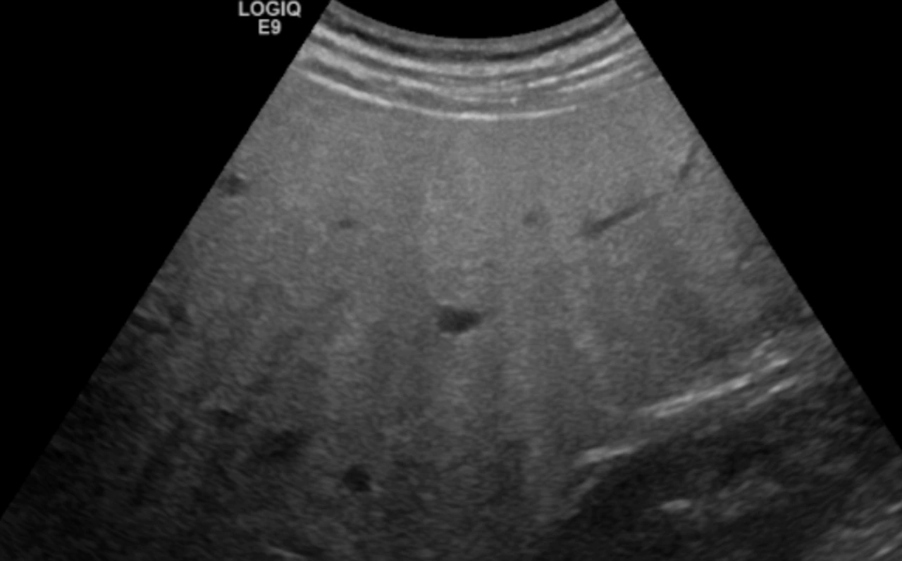 Fettleber in der Ultraschall-Untersuchung